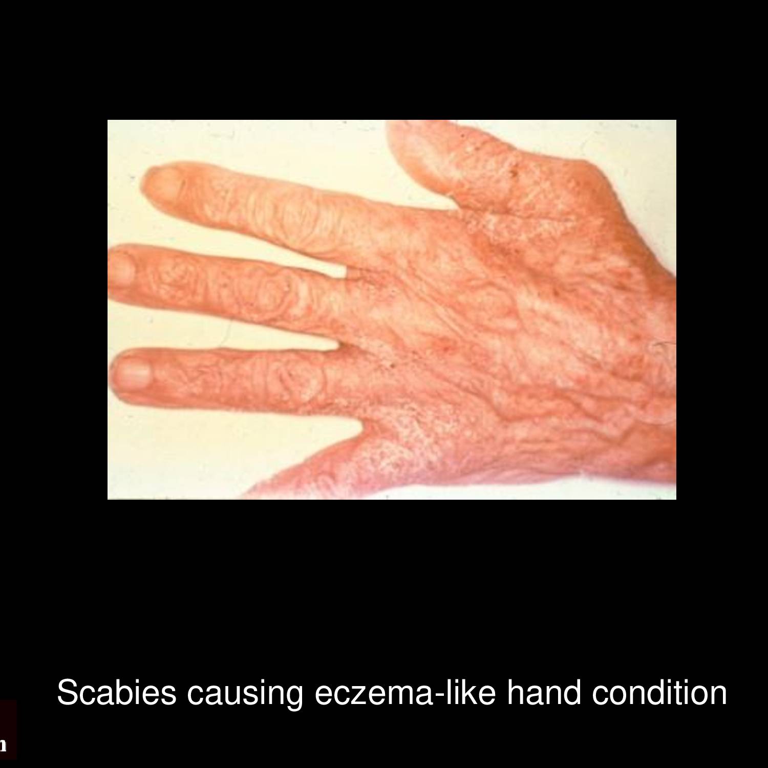 Scabies nodules on male genitalia showing persistent erythematous nodular lesions in scrotal region as hypersensitivity reaction to mite antigens